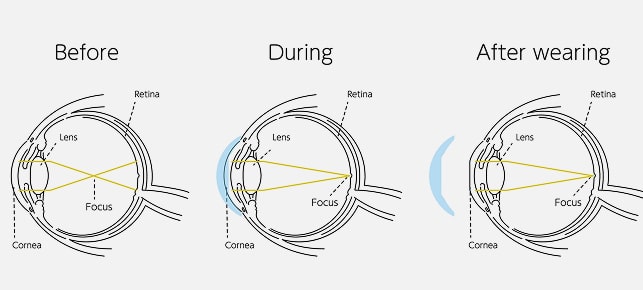 Orthokeratology